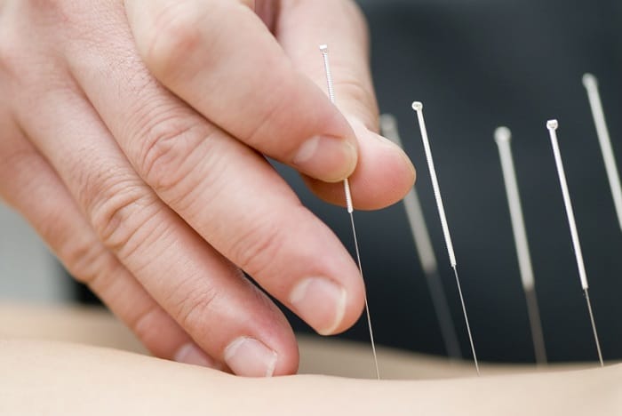 Dry needling / Acupuncture